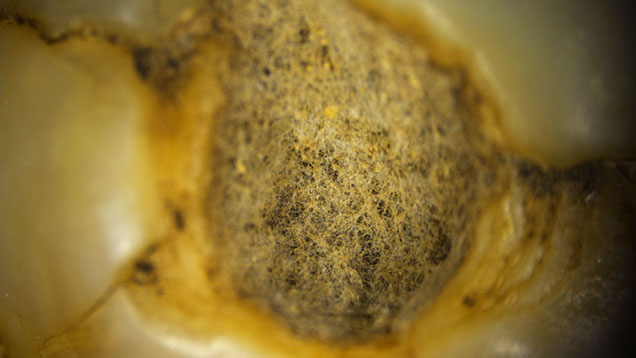 Figure 1. Spiderweb-like structure on the non-nacreous base of a natural pearl. Photomicrograph by Eram Shaikh; field of view 2.00 mm. Figure 1. Spiderweb-like structure on the non-nacreous base of a natural pearl. Photomicrograph by Eram Shaikh; field of view 2.00 mm.