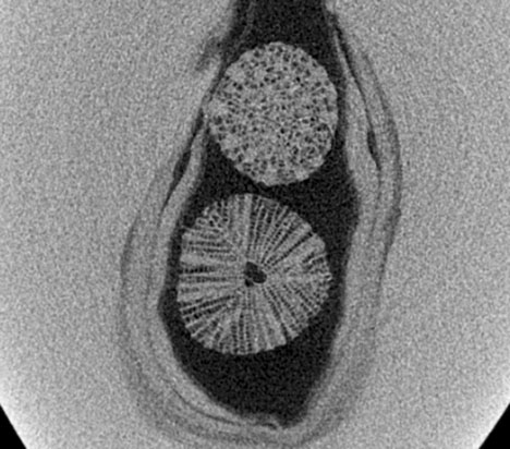 Figure 3. A distinctive porous and radial structure extends outward from the chamber central core of the two white microscopic marine organisms within the elongated dark gray void of the 2.33 ct pearl. Figure 3. A distinctive porous and radial structure extends outward from the chamber central core of the two white microscopic marine organisms within the elongated dark gray void of the 2.33 ct pearl.