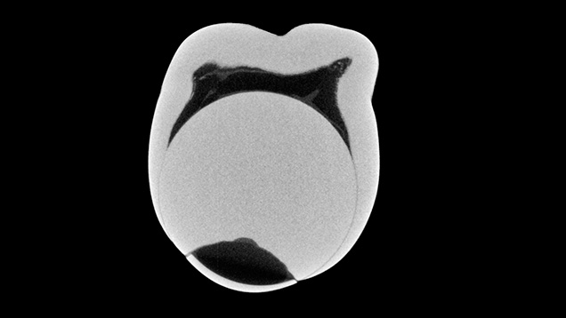 X-ray of assembled, bead-cultured pearl