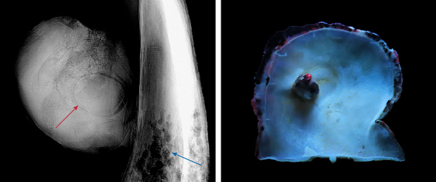 Figure 3. Left: A real-time microradiograph image showing the internal structure of the blister pearl consisting of an organic-rich core surrounded by concentric growth arcs (red arrow) with parasite holes in the host shell (blue arrow). Right: Strong orangy red reaction under long-wave UV light, observed on the edge of the shell and part of the black area on the blister pearl. Photos by Lubna Sahani (left) and Gaurav Bera (right).