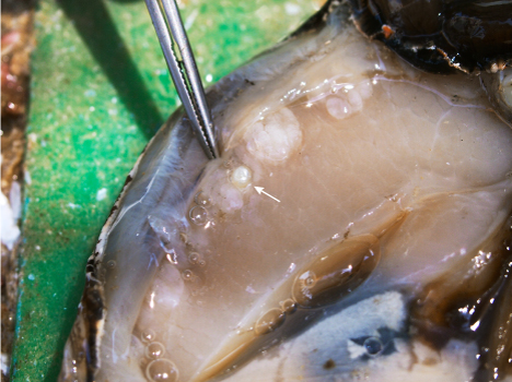 Seed pearl found embedded in the adductor muscle Seed pearl found embedded in the adductor muscle