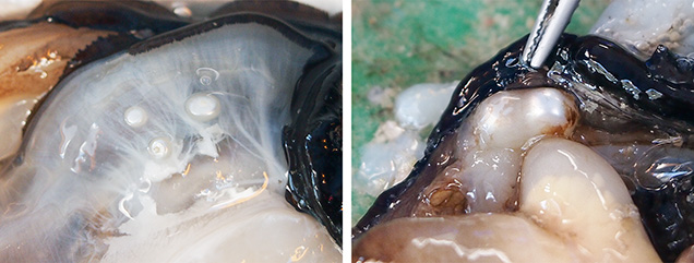 Pearls found in adjacent sacs or within the same sac Pearls found in adjacent sacs or within the same sac